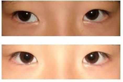 孩子眼睛模糊，就是近視？