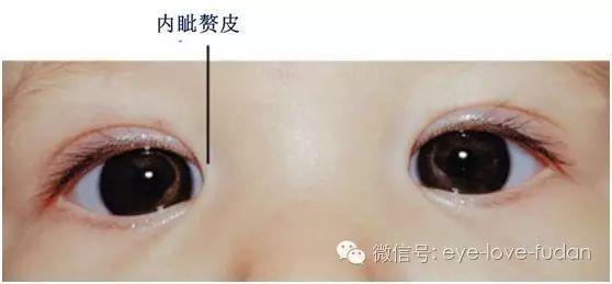 關(guān)于眼健康的傳言與真相