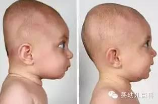孩子的頭型與睡枕頭有關系嗎? 孩子的頭型與睡枕頭有關系嗎?