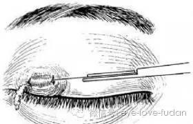 小孩長針眼怎么辦？