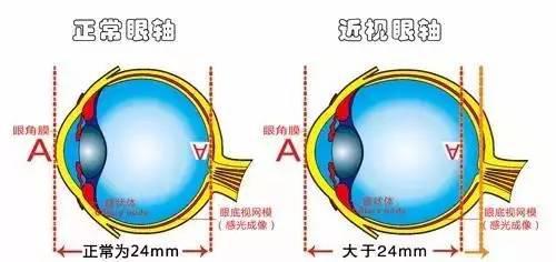 弱視是怎么形成的?它與近視有哪些區(qū)別? 弱視是怎么形成的?它與近視有哪些區(qū)別?
