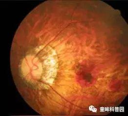 你不得不知的兒童近視幾大問(wèn)題 你不得不知的兒童近視幾大問(wèn)題