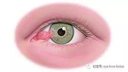 人眼為什么會長“多肉”？