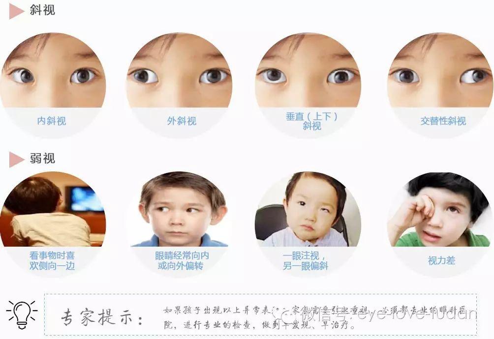 孩子斜弱視治療，不要錯過關鍵時機