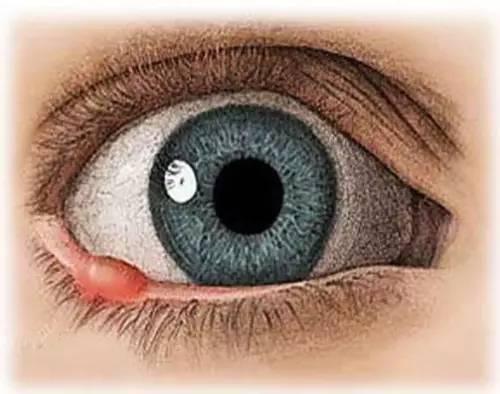 孩子長針眼怎么辦？