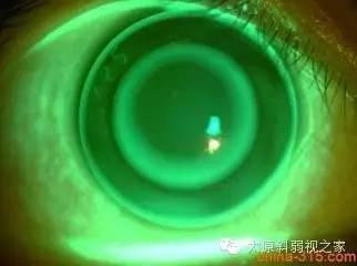 配戴角膜塑形鏡不可不知的小常識 配戴角膜塑形鏡不可不知的小常識