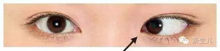 怎樣區(qū)別你的寶寶是否有斜視眼？