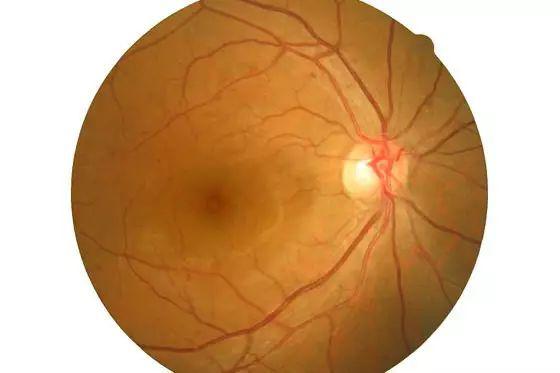 白內障術后仍然模糊怎么回事？