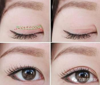 雙眼皮術(shù)前術(shù)后的注意事項