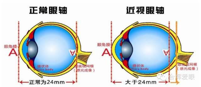 眼鏡戴久了,眼睛會變形嗎? 眼鏡戴久了,眼睛會變形嗎?