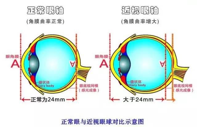 孩子近視度數猛漲？近視防控小心誤區！