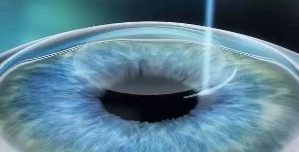 近視手術(shù)安全嗎？