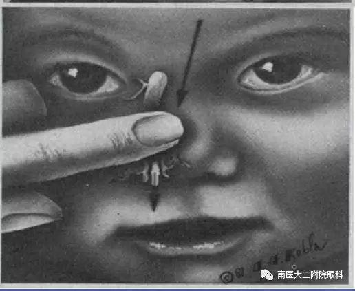 先天性淚道阻塞如何進行按摩？