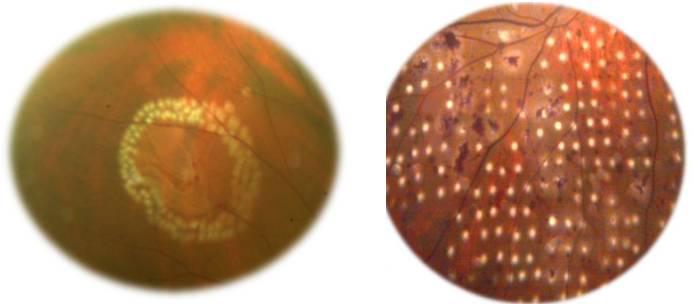 眼底打激光是怎么回事？