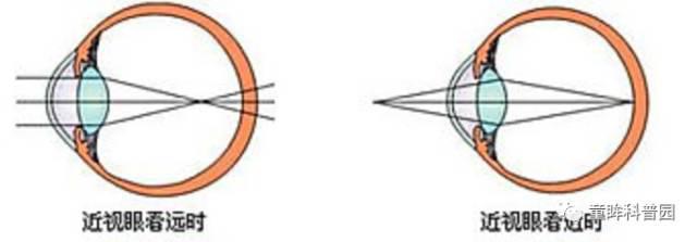 你不得不知的兒童近視幾大問(wèn)題 你不得不知的兒童近視幾大問(wèn)題