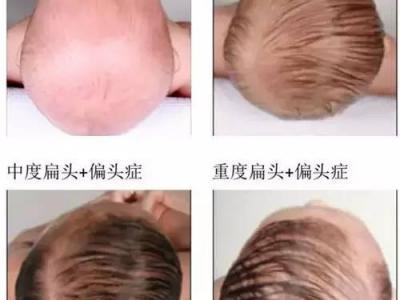 雙眼皮術(shù)前術(shù)后的注意事項