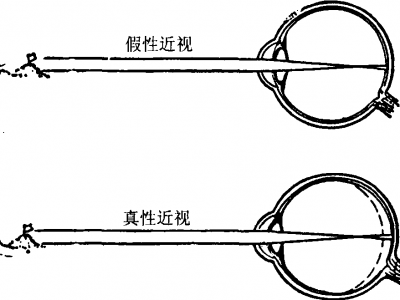 近視不戴眼鏡瞇眼睛都有哪些危害？