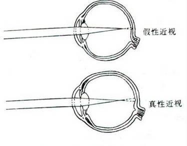 如何辨別真性近視和假性近視？