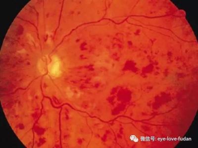 糖尿病眼底病變的病人，請注意！