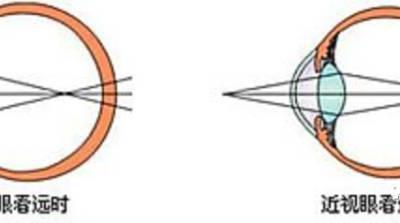 眼疲勞防治，你需要知道的那些事