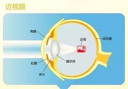 近視的原因、預防與治療
