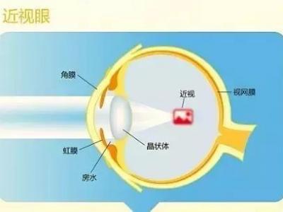 近視的原因、預防與治療