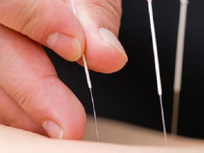 治療內分泌失調針灸有效嗎? 中醫針灸治療內分泌失調效果好
