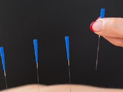 蕁麻疹的針灸治療方法有哪些 中醫治療蕁麻疹的6種針灸方法