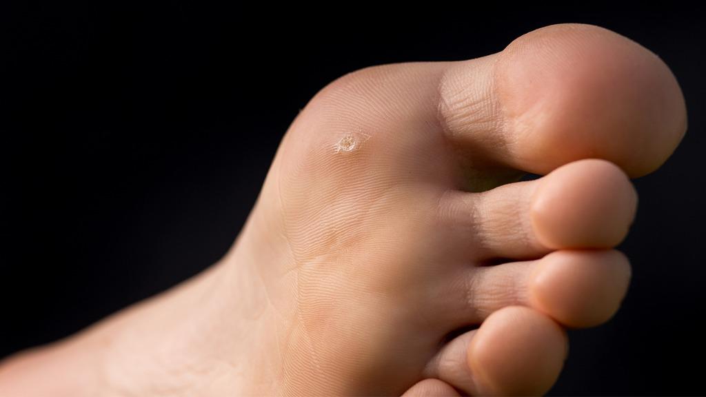 雞眼長見的部位有哪些 中醫(yī)針灸治療雞眼的方法