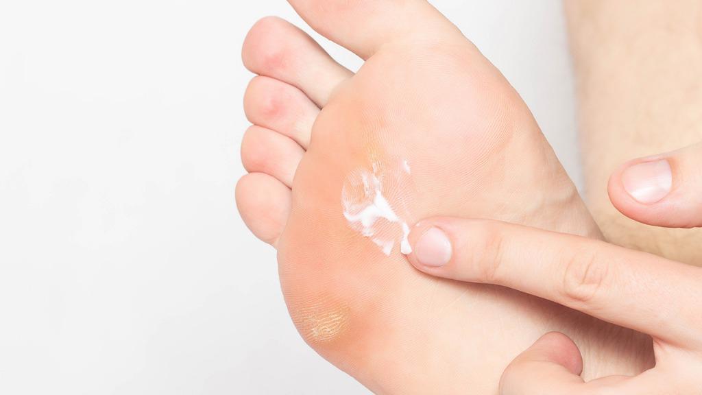 雞眼長見的部位有哪些 中醫(yī)針灸治療雞眼的方法