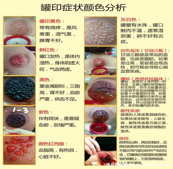 拔罐顏色癥狀對照表圖解，深淺代表不同病癥(越淺越好)