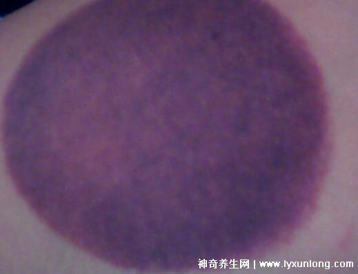 拔罐顏色癥狀對照表圖解，深淺代表不同病癥(越淺越好)