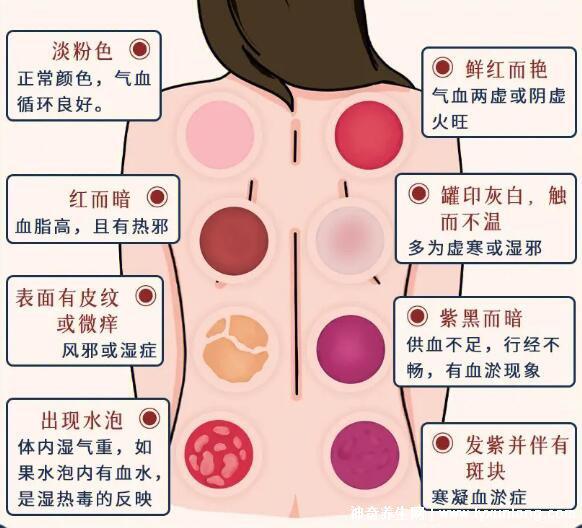 拔罐顏色癥狀對照表圖解，深淺代表不同病癥(越淺越好)