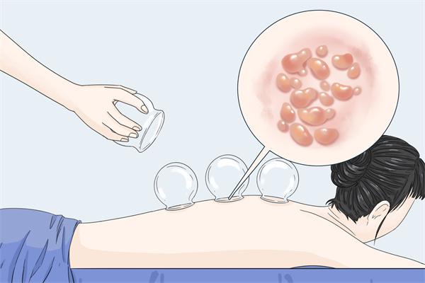 拔罐后可以吹空調嗎