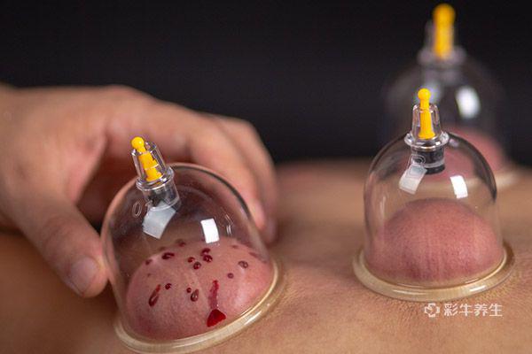 拔罐多久一次合適