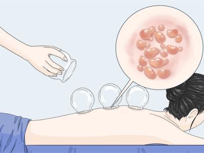 拔罐后可以吹空調(diào)嗎