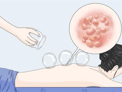 拔罐的好處和壞處有哪些